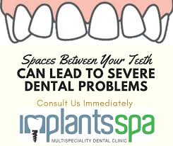 We did not find results for: Implants Spa Multispeciality Dental Clinic Dentist Braces Root Canal Wisdom Teeth Dentist Near Me Affordable Dentures Teeth Whitening Veneers Dental Implants Wisdom Teeth Removal Toothache Gentle Dental Dentures Invisalign Cost Pediatric