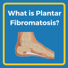 No one is sure why these occur. What Is Plantar Fibromatosis Heel That Pain
