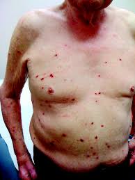 Image result for Neurodermatitis