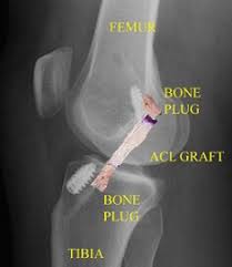 Knee Operation Surgery Information Knee Pain Explained