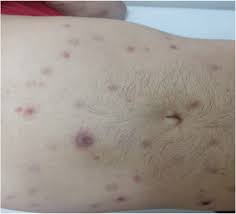 Blotchy red rash on the hands or soles of. Atypical Secondary Syphilis Presentation In A Patient With Human Immunodeficiency Virus Infection A Case Report Journal Of Medical Case Reports Full Text