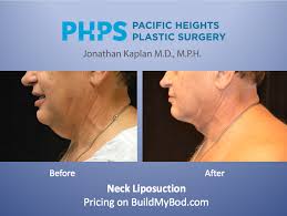 An adam's apple is an anatomical structure which appears primarily in males. Get Your Adam S Apple Back Video Buildmybod Health