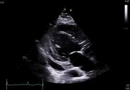 Image result for Post-MI Pericarditis