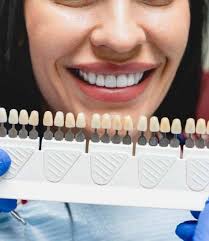 Dental Veneers