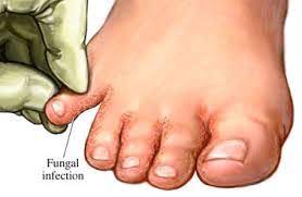 How To Treat Athletes Foot Tricks Tips Foot Ankle