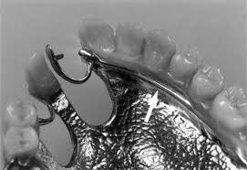 This type of prosthesis is referred to as a removable partial. Support Of Removable Partial Dentures In Situations With A Unilaterally Missing Canine And A Curved Edentulous Ridge Journal Of Prosthetic Dentistry