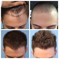 Are Looking For PRP Hair Loss Treatment In Hyderabad | Hyderabad ...