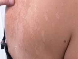 Cara hilangkan panau seterusnya ialah dengan menggunakan tea tree. Hilangkan Kulit Berpanau Dengan Shaklee Stokis Dyxy Putrajaya Cyberjaya Bangi