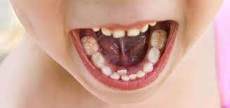 Que Hacemos Si A Un Nino Le Sale El Diente Definitivo Por Detras Del De Leche Aixerrota Clinica Dental