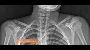 Image result for SC Dislocation