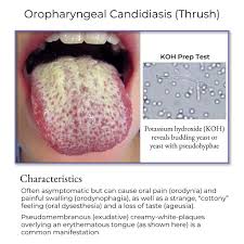 Image result for Candidiasis