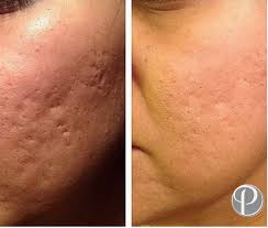 Acne scar revision is a surgical technique which excises deeply pitted scars and sutures together the open edges of skin. Pin On Acne Scars Before And After