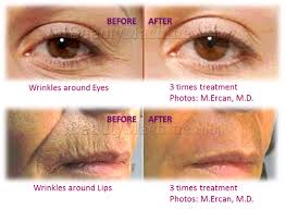 How to prepare for your microneedling treatment? Ibeautypen Motorized Micro Needle System 12 Needle Rechargeable German Motor Dermapen Eclipse Micropen Skinpen
