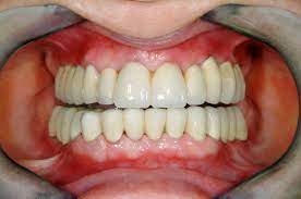 Metoprolol tartrate should not be stopped abruptly. Tartre Au Pourtour Des Implants Bucco