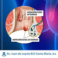 La trombosis hemorroidaria es la presencia de coágulos sanguíneos en los plexos hemorroidales interno o externo. Sintomas Los Signos Y Sintomas De Las Abc Noticias Ica Facebook