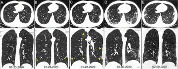 Thoracic— refers to the chest area. Ct Provides Best Diagnosis For Novel Coronavirus Covid 19 Imaging Technology News