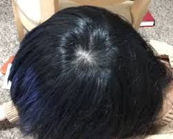 No two hair patterns are the same. Is This A Normal Hair Whorl Or Is It Hair Loss Photo
