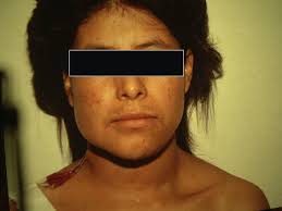 Cervical lymphangioma in the adult. A report of 2 cases