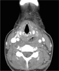 47 it is also present in 26% of women with symptoms who are seen in sti clinics and is highly prevalent. Unusual Case Of Pharyngitis Photo Quiz American Family Physician