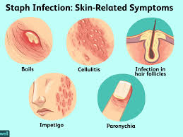 What are the signs & symptoms of mrsa? Staph Skin Infections And Mrsa Treatments