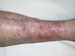 Image result for Stasis Dermatitis