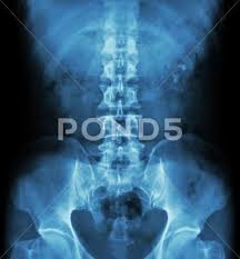 Kidney Stone Renal Stone Renal Calculi Film X Ray Kub Kidney Uret Stock Photos Ad Calculi Film Renal Kidney Renal Stones Renal Calculi Renal