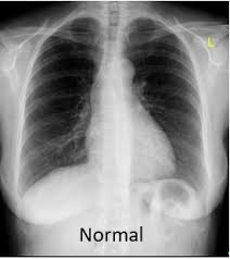 Xray on the right also. Copd Doctor Chronic Obstructive Pulmonary Disease Chestmed
