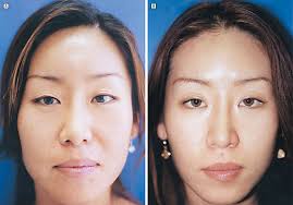 Botulinum Toxin for Masseter Reduction in Asian Patients