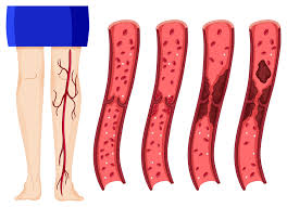 Trombose venosa (trombose e embolia pulmonar). Trombose Venosa Profunda I Dra Nayara Cioffi Batagini