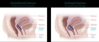 Image result for Fecal Incontinence