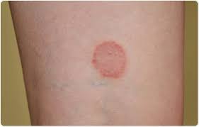 The plaques were mostly on the trunk and upper limbs and although they were initially pruritic they were otherwise asymptomatic. Lichen Planus Lp Skin Condition
