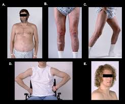 Image result for Lipodystrophy