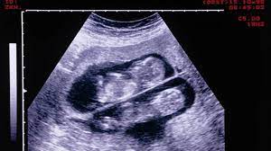 Forschung Zwillinge Zwillinge Zwillinge Babyzimmer Ultraschall Zwillinge