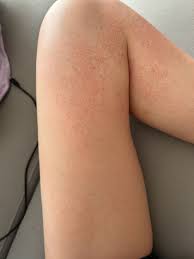 腿上莫名長好多紅點😭 - 女孩板| Dcard