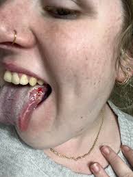 Image result for mouth ulcer on tongue)