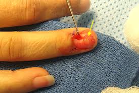Image result for Glomus tumor