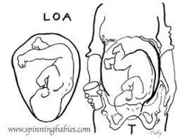 The occiput refers to the back of the baby's head. Left Occiput Anterior Loa Spinning Babies
