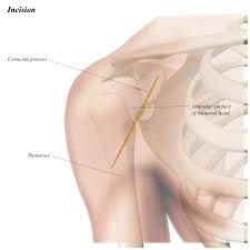 Anterior graphic of the shoulder. Shoulder Anterior Deltopectoral Approach Approaches Orthobullets