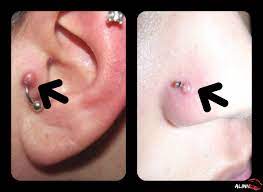 Things That Go Bump On Your Piercing Nose Piercing Bump Piercing Bump Skin Piercing