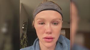 Experiencing lip swelling after having the moderna vaccine in particular. Concerns Raised Over Potential Interaction Between Covid Vaccine And Cosmetic Fillers Youtube