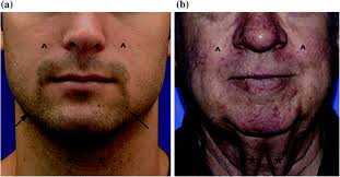 Head and Neck During Puberty and Ageing