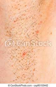 Ingrown hairs can be more common in people with coarse or curly hair. Ingrown Hair After Shaving Close Up Photo Of Ingrown Hair After Shaving Canstock