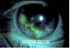 Goz Ucugu Nasil Bulasir Bulasma Icin Yakin Kisisel Temas Gereklidir Genellikle Cocuklugumuzda Dudaktaki Ucuklar Ve Salgilardan Virusu Kapa Gozler Gece Dudak