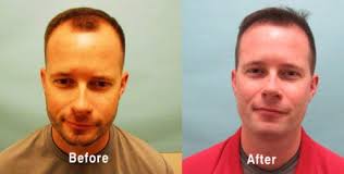 You can also get an idea of the process by looking at the. 1600 Fue Graft Case Study Hair Transplant Case Study Mcgrath Medical
