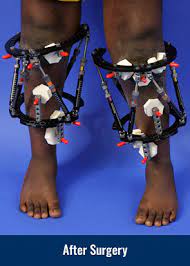 Bowlegs | International Center For Limb Lengthening