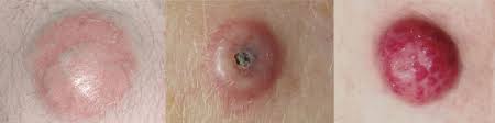 Image result for Merkel Cell Carcinoma