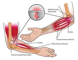 Arrangement of forearm muscles and tendons in the wrist. Vacuum Cupping For Lateral Elbow Pain Stuart Hinds Performance Therapy