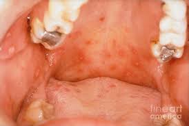 Image result for Oral herpes roof of mouth