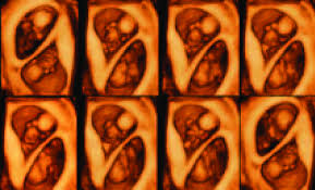 We did not find results for: 4d Us Sequence Of A Ba Bc Twin Pregnancy At 10 Weeks Gestation Both Download Scientific Diagram