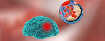 Nach einer tia, einer transitorischen ischämischen attacke, werden die meisten patienten sagen: Schlaganfall Focus Arztsuche